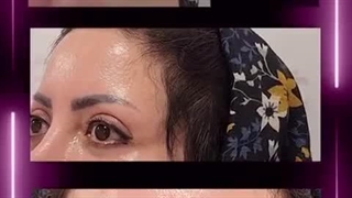 کاشت ابرو در کلینیک آوینا