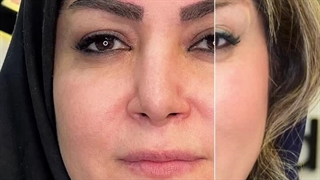 کاشت ابرو در کرج | کاشت ابرو، تحول در زیبایی چهره