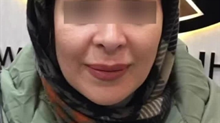 کاشت ابرو در کرج | ابروهای پرپشت، جذابیت بی‌پایان