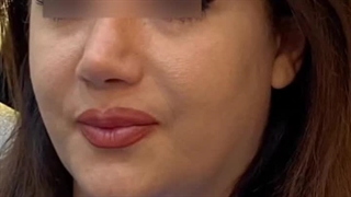 کاشت ابرو در کرج | زیبایی چهره با ابروهای طبیعی و کامل