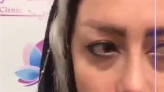 کاشت ابرو در کلینیک آوینا