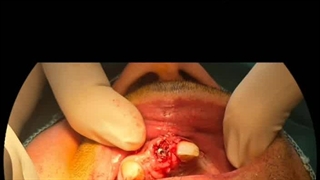 ایمپلنت اول آقای غریبی در کلینیک دکتر پورصادقی