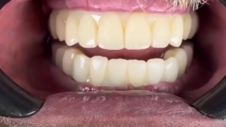 Same day implant smile | digital implant in shiraz