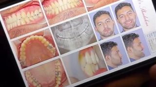 درمان جلو بودن فک پایین با ارتودنسی