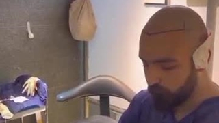 کاشت مو نازنین عسکری در شیراز