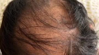 کاشت مو نازنین عسکری در شیراز
