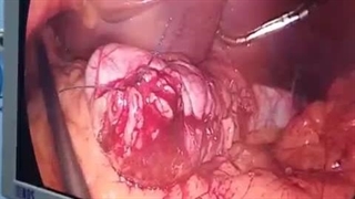 فیلم جراحی اسلیو معده