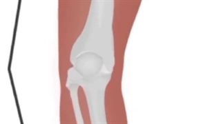 اگه زانوت پرانتزیه این حرکت رو انجام بده