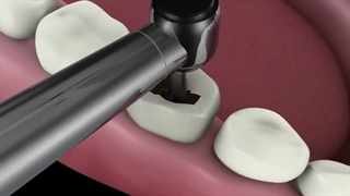 ترمیم دندان پوسیده