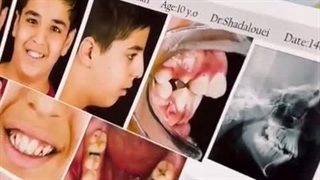 ارتودنسی در سن پایین