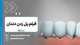 پل دندان بهتر است یا ایمپلنت - پزشک 24