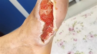 بررسی بیمار (متمم_زخم) 2