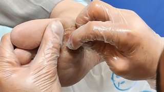 آموزش نحوه تراشیدن کالوس (متمم_زخم) 1