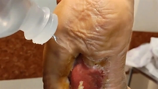 نحوه پاکسازی زخم از اسلاف و کراست (متمم_زخم)