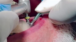 فیلم کاشت ایمپلنت در کلینیک دندانپزشکی دکتر احمدی زاده