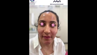 نمونه‌کار برای تزریق بایوفیلر (4)