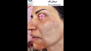 قبل و بعد از درمان لک پوستی صورت