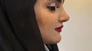 دو سال پس از جراحی بینی (دکتر ندا سخی)
