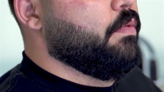 کاشت ریش در ناحیه سوختگی | بازگشت طبیعی موها در آرمو کلینیک