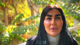 نتیجه کاشت ابرو بعد از یکسال