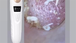 فیلم تخلیه جوش سر سیاه و سر سفید با دستگاه خانگی