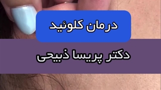 نتیجه مثبت برداشتن کلوئید گوش با تکنیک‌های تخصصی دکتر پریسا ذبیحی