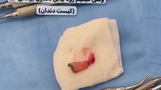 کیست دندان دلیل مراجعه دیروقت به دندان پزشکی