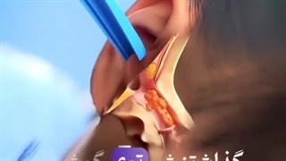 چرا شمع گوش برای تخلیه جرم گزینه خوبی نیست؟