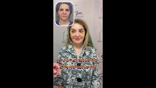 أصغر بعشرین عامًا - عملیة شد الوجه والرقبة والشفة الوسطى والجفن العلوی