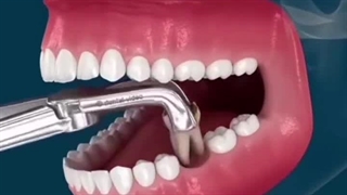 اگر دندان کشیده شده جایگزین نشود چی؟