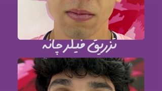 فیلر چانه در کلینیک آوینا