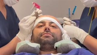 موهایی پرپشت و طبیعی با پیشرفته ترین تکنیک های کاشت مو