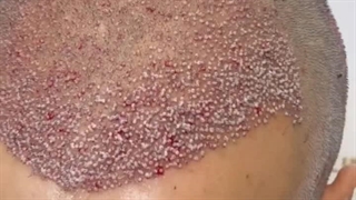 کاشت مو با بالاترین تراکم