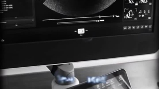 سوارخ ریز در قلب نشانه چیست؟