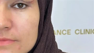 بلفاروپلاستی با تکنیک بلفالیفت