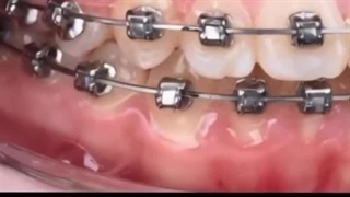 آوردن دندون نیش تو قوس فکی با ارتودنسی