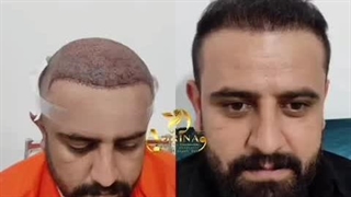 نمونه کاشت مو کلینیک آدرینا (اکبرپور)