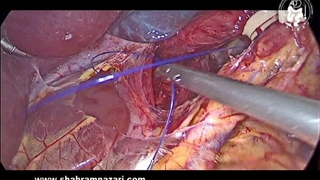 جراحی ضد ریفلاکس, طول مری داخل شکمی, بستن هیاتال (کروپلاستی).