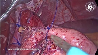 عمل جراحی لاپاراسکوپی نیسن فوندوپلیکاسیون برای ریفلاکس