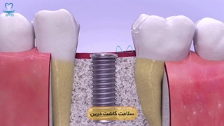 روش‌های کاشت ایمپلنت دندان | سلامت کاشت درین