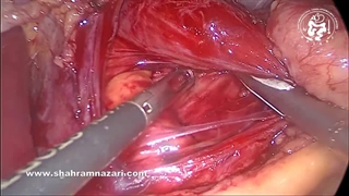 لیپوم مدیاستینال اتفاقی در طی عمل لاپاراسکوپی نیسن فوندوپلیکاسیون. استراتژی جراحی چیست؟