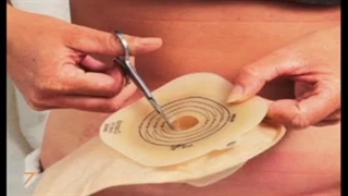 تخلیه و تعویض کیسه کلستومی