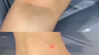 کلینیک زیبایی مه نگار-کربن تراپی-روشن کردن پوست - پاک کردن نواحی تیره زیر بغل بیکینی زانو و قوزک پا