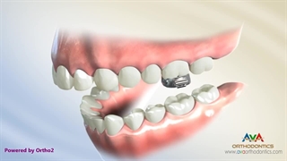 ارتودنسی ثابت