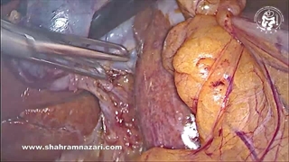 کیسه صفرای نابجای بطنی روی مجرای کبدی با شریان‌های سیستیک دوگانه شناسایی و استراتژی حین عمل