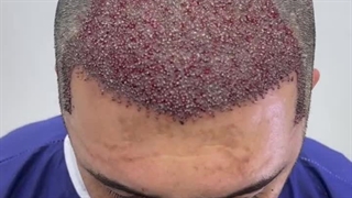 نمونه کاشت مو خانم بهروزی