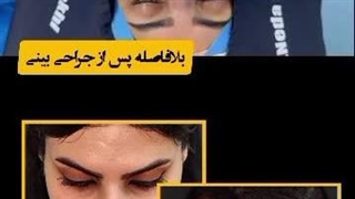بلافاصله بعد از جراحی بینی