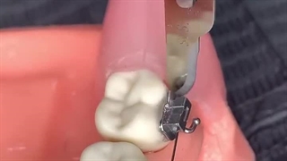 درمان دندان لق شده در بزرگسالان